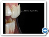 Faceta IPS e-max dente 11 e 21 